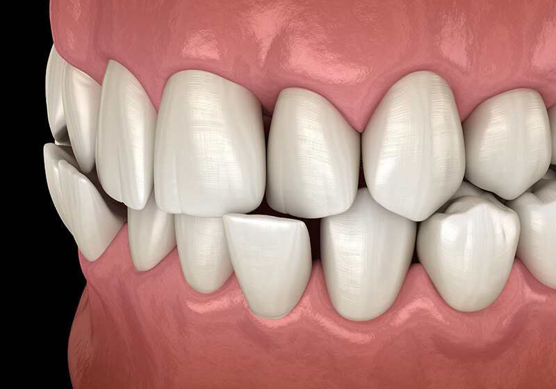 乱れた歯並びが身体に与える影響