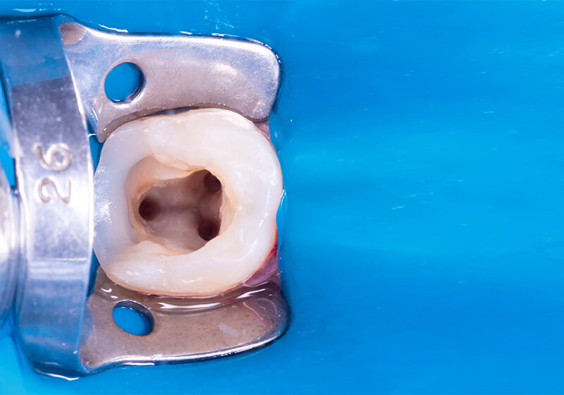 歯科用拡大鏡（ルーペ）を使用した精密治療