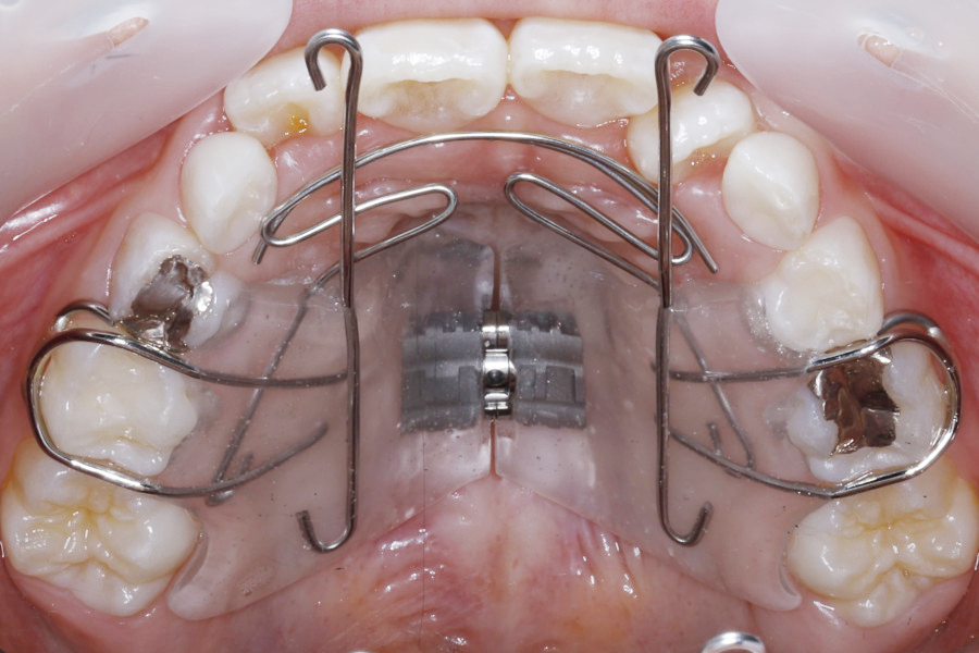 非抜歯矯正②