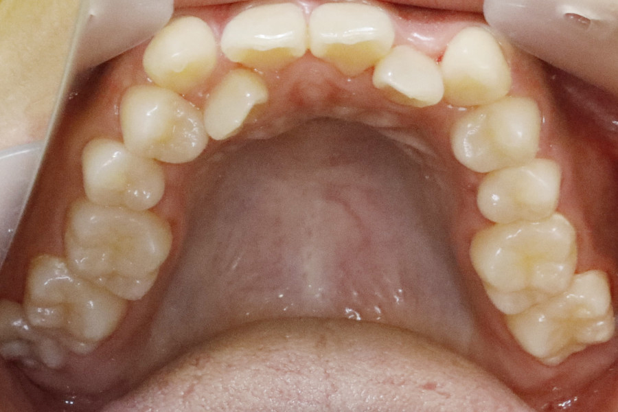 非抜歯矯正③