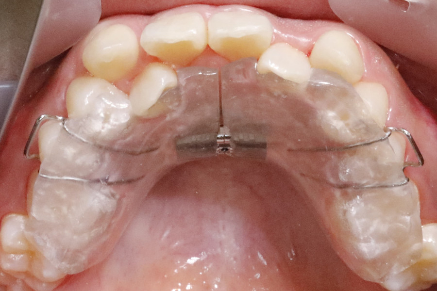 非抜歯矯正③