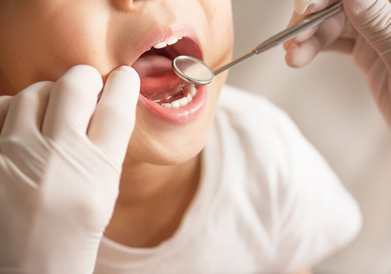 ②虫歯や歯周病のリスクを軽減できる