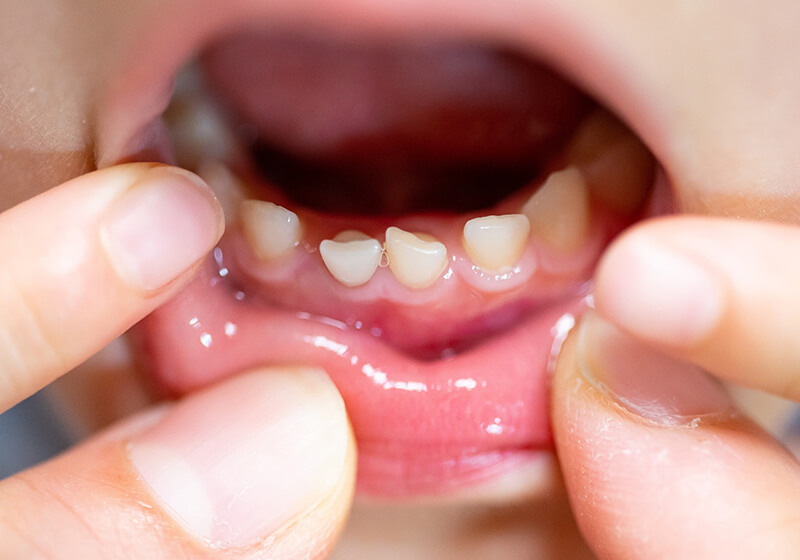 理由その1子供の歯はエナメル質が少ない