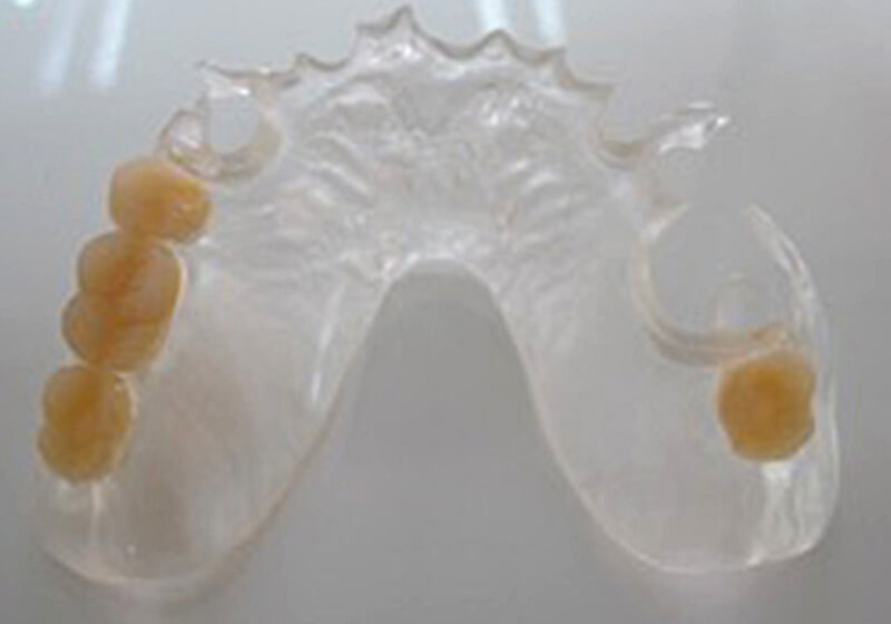 クリアノンクラスプデンチャー