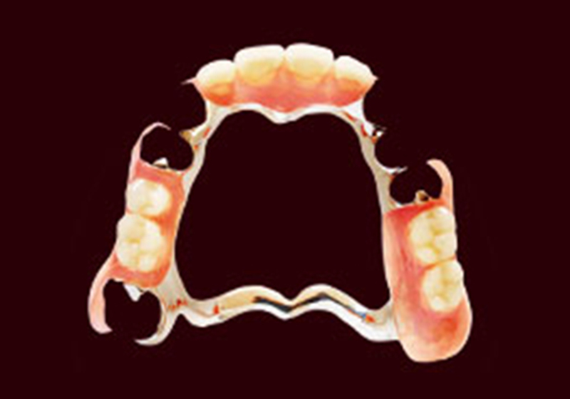 金属フレーム+ノンクラスプデンチャー