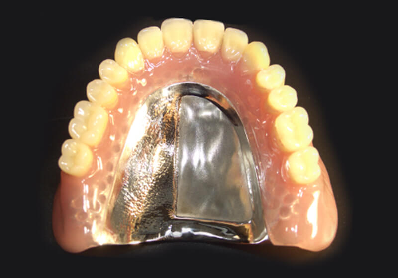 トルティッシュデンチャー