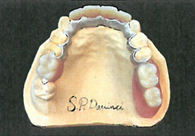 ブリッジ・デンチャー・ダヴィンチ(S.P.davinci)