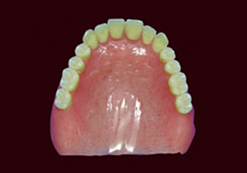 熱可塑性義歯