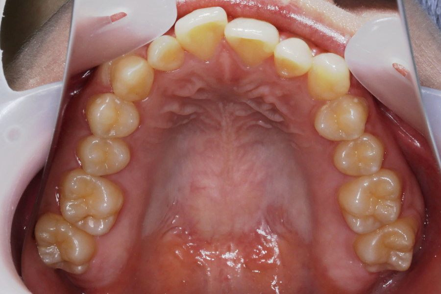 インビザラインにて矯正した例②
