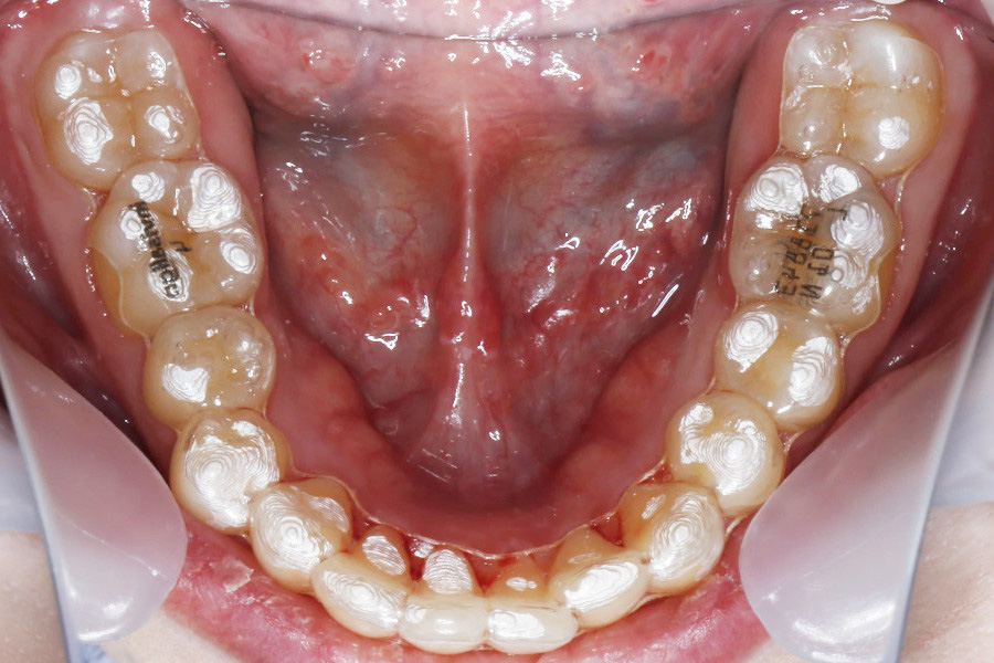 インビザラインにて矯正した例②