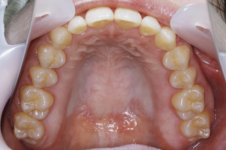 インビザラインにて矯正した例②