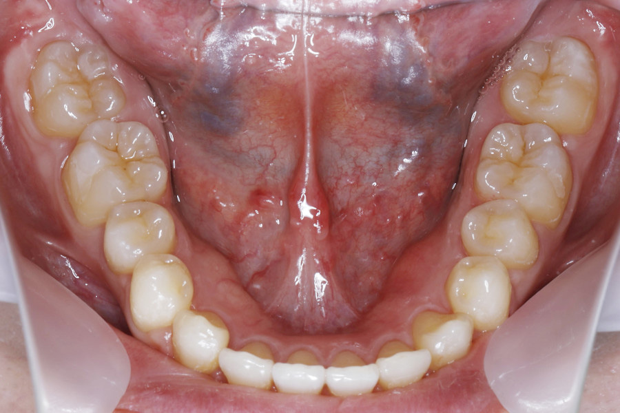 インビザラインにて矯正した例②