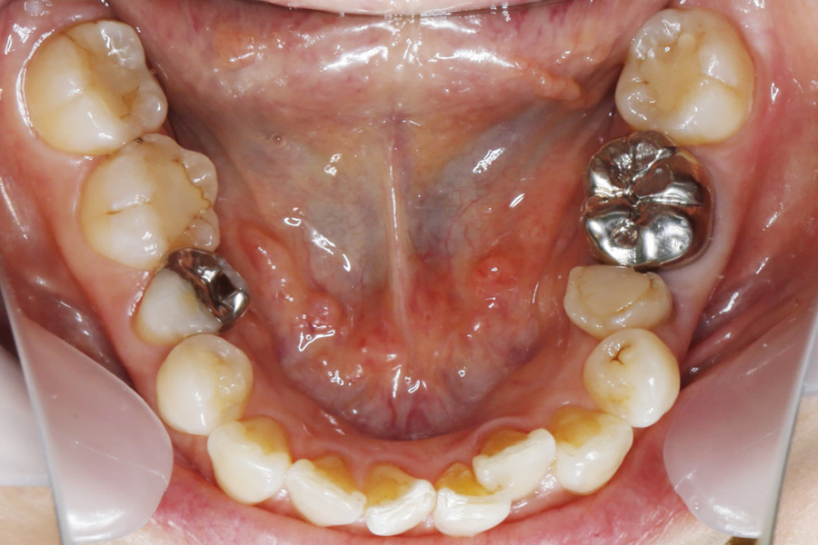 歯列拡大装置を併用したワイヤー矯正①