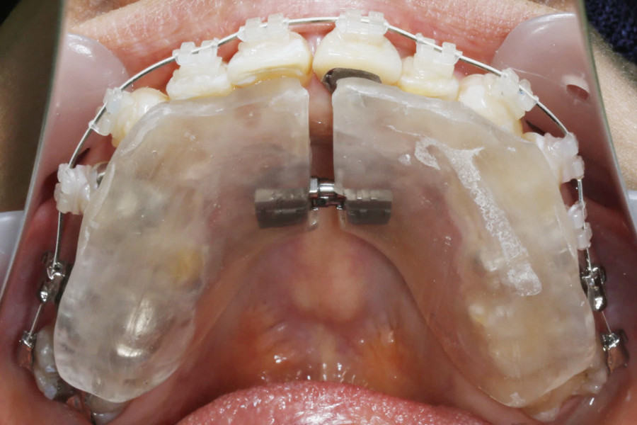 歯列拡大装置を併用したワイヤー矯正①