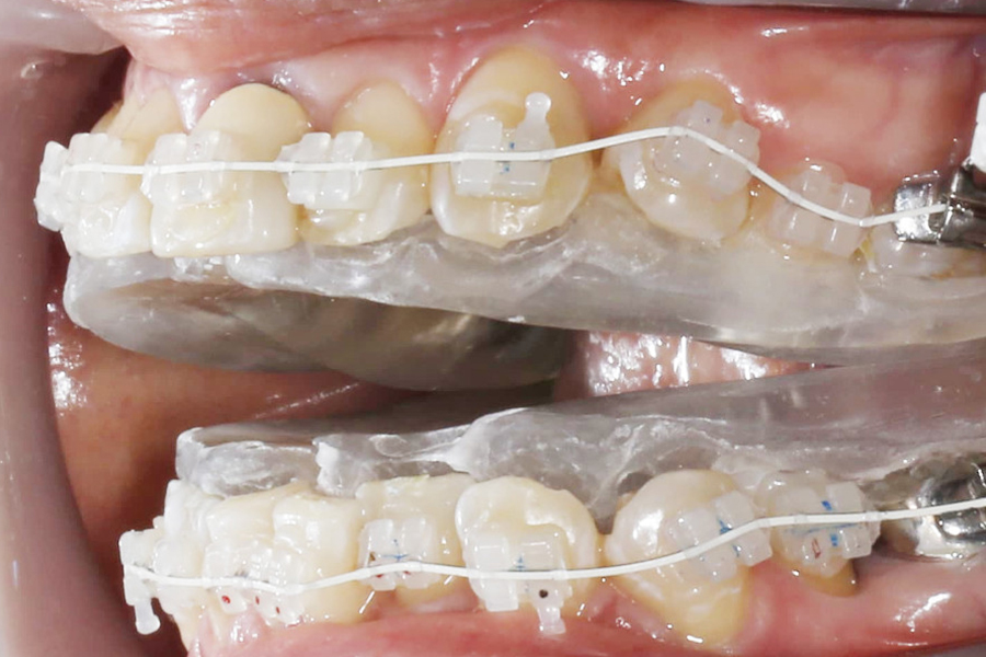 歯列拡大装置を併用したワイヤー矯正①