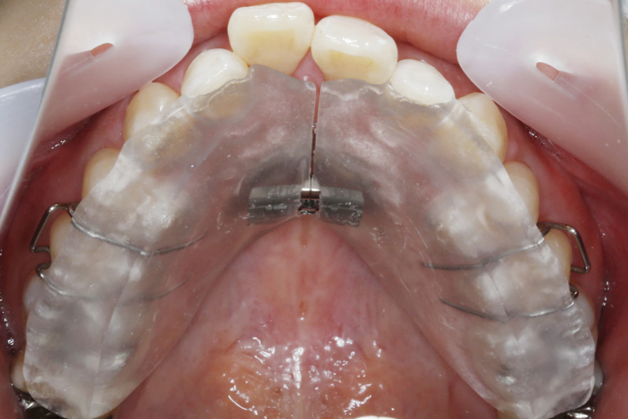 歯列拡大装置を併用したワイヤー矯正②