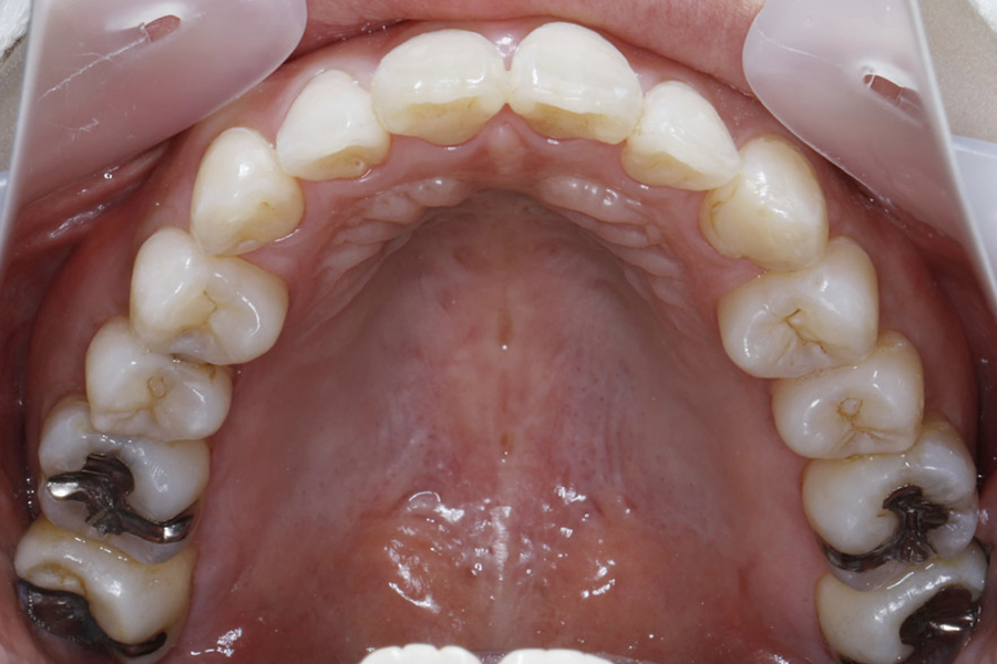 歯列拡大装置を併用したワイヤー矯正②