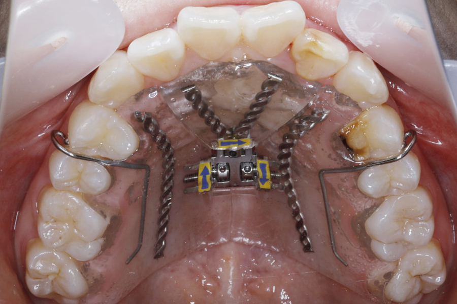 歯列拡大装置を併用したワイヤー矯正③
