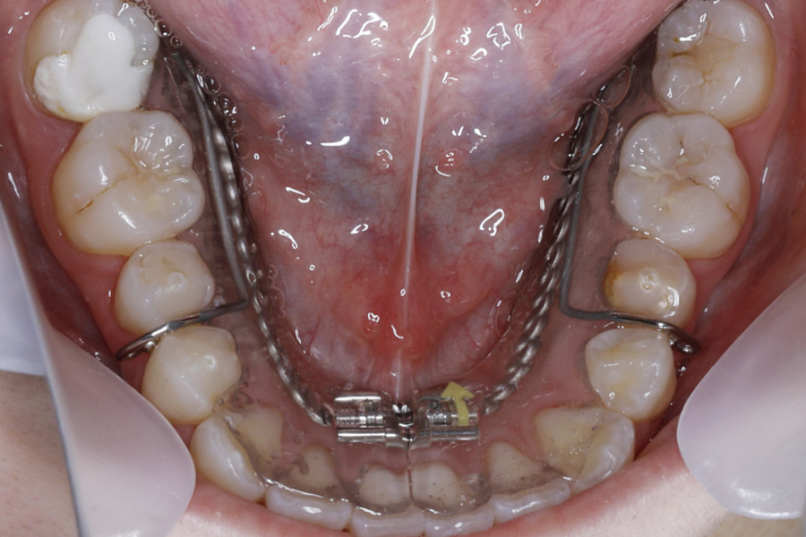 歯列拡大装置を併用したワイヤー矯正③