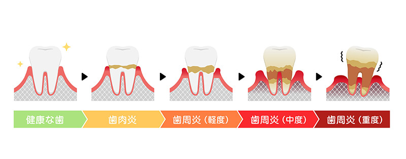 日本人の歯を失う原因第1位「歯周病」