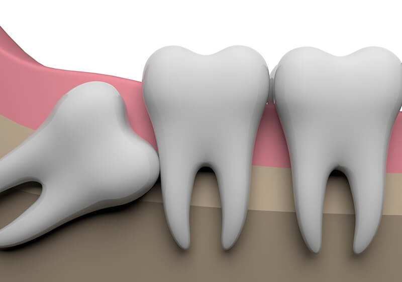 モリカゲ歯科医院は親知らずの抜歯の経験が豊富です